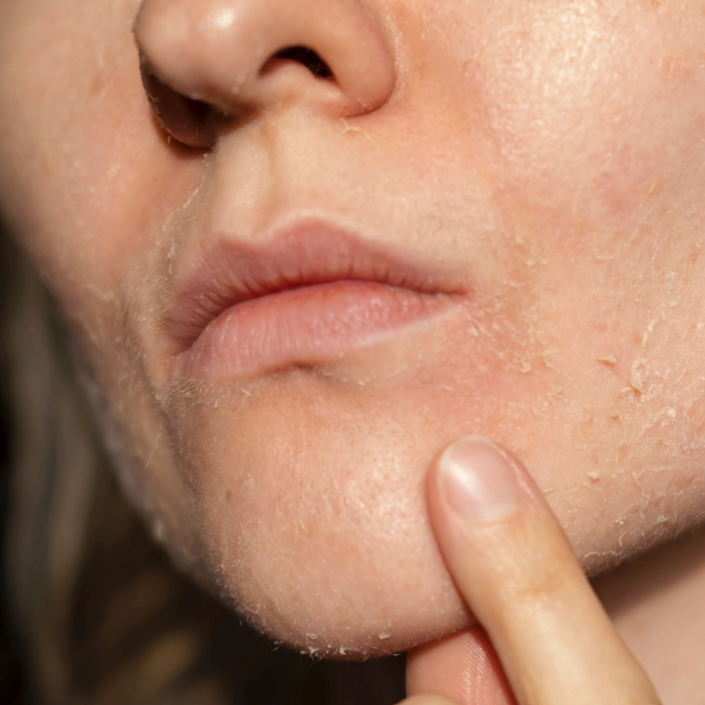 Dry & Dehydrated Skin